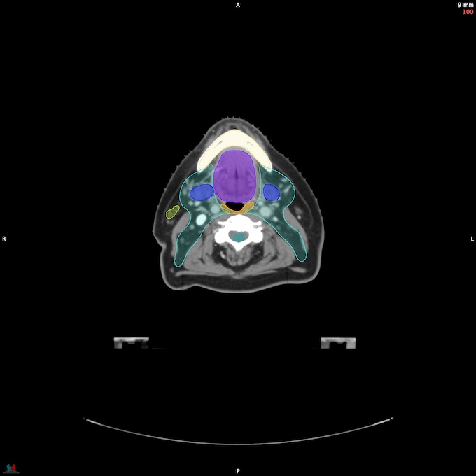 CT__SPINALCORD_23