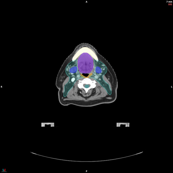 CT__SPINALCORD_24