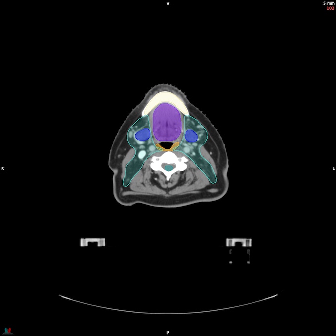 CT__SPINALCORD_25