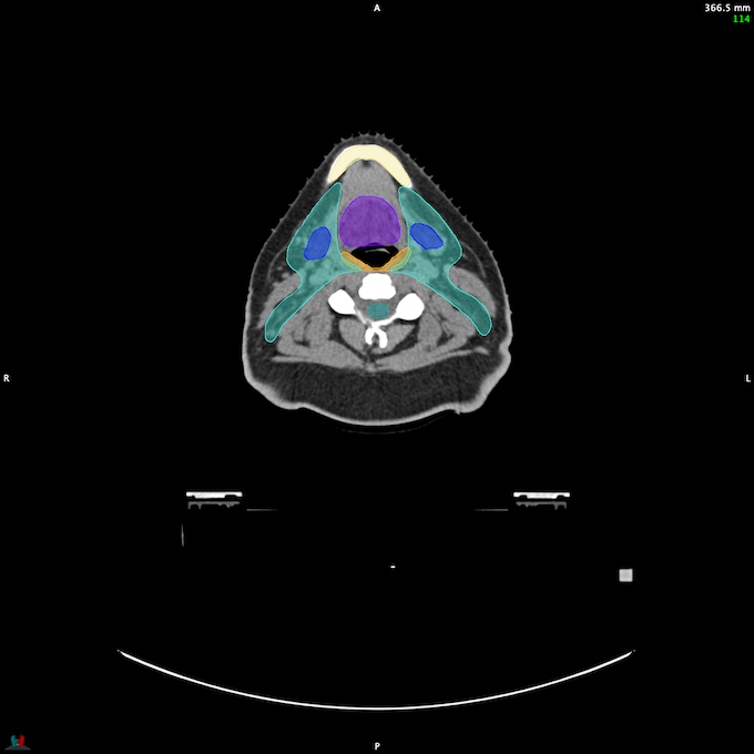 CT__SPINALCORD_25