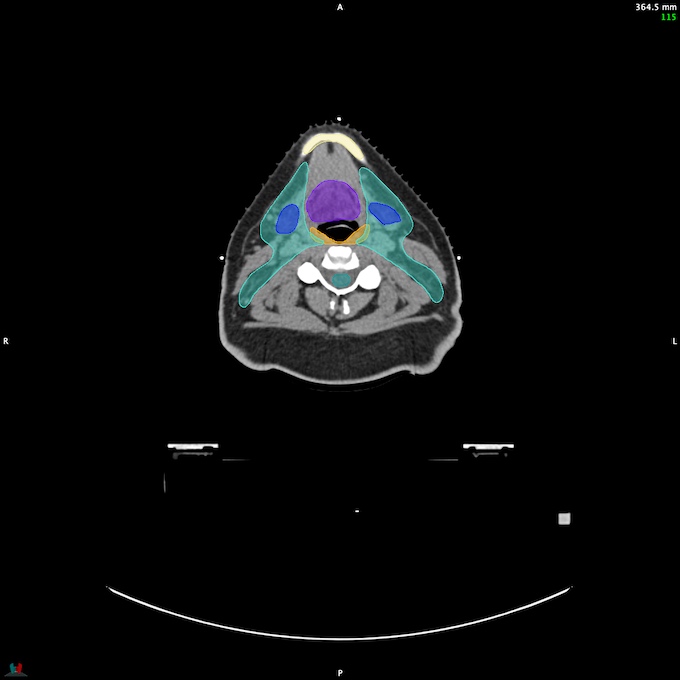 CT__SPINALCORD_26