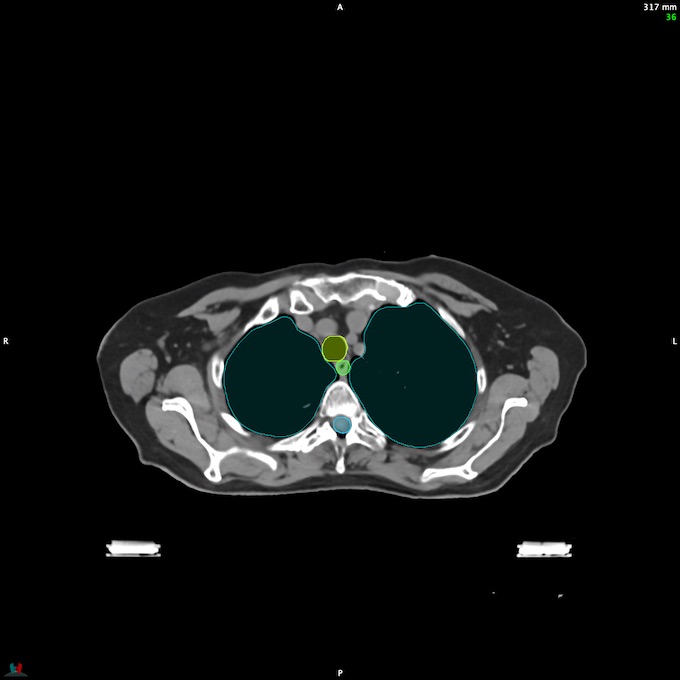 CT__SPINALCORD_35