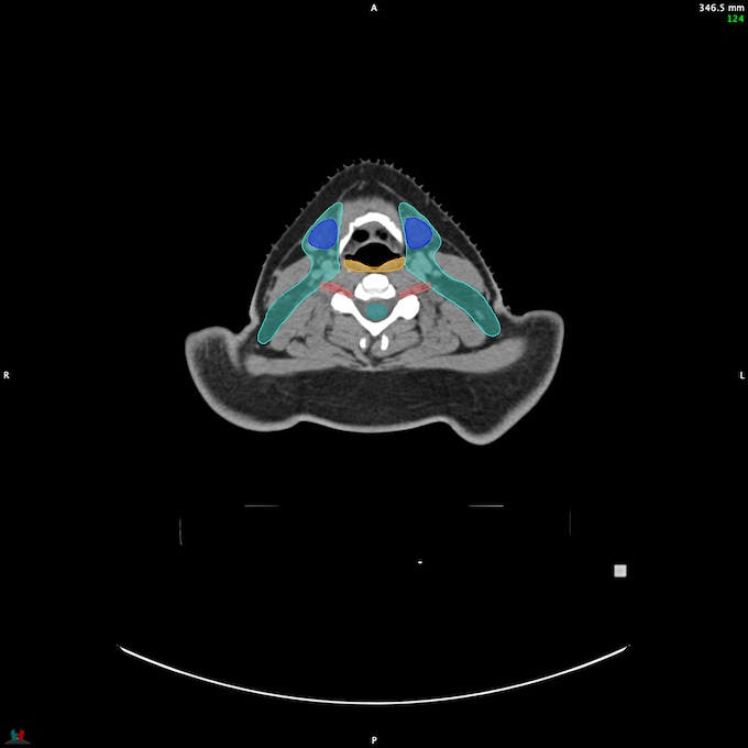 CT__SPINALCORD_35