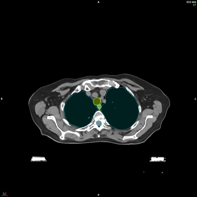 CT__SPINALCORD_36