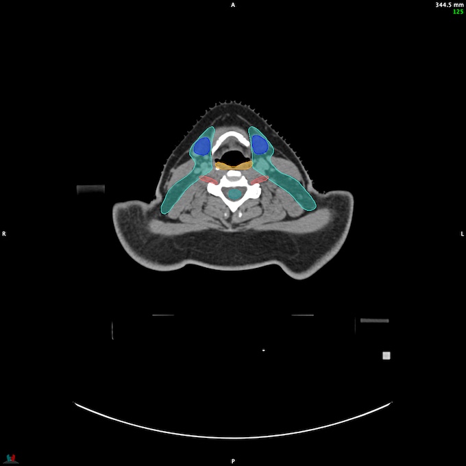 CT__SPINALCORD_36