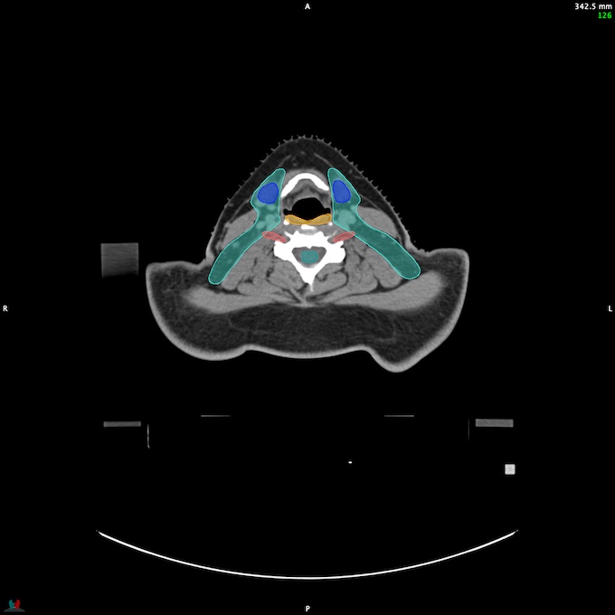 CT__SPINALCORD_37