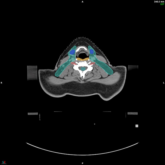 CT__SPINALCORD_38