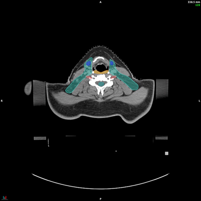 CT__SPINALCORD_39