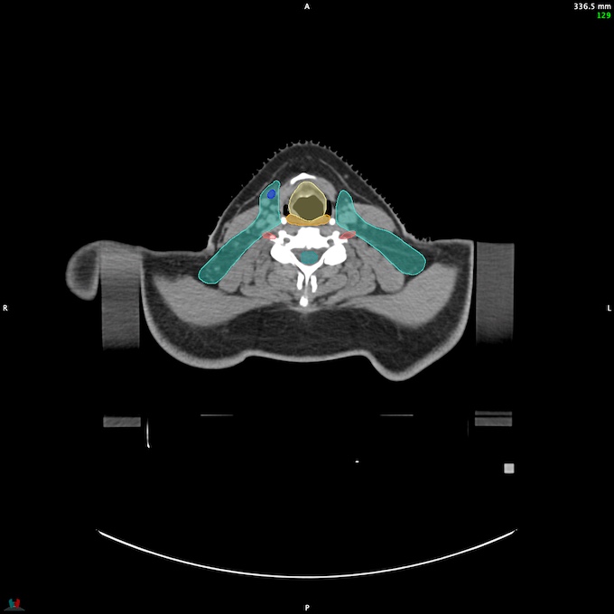 CT__SPINALCORD_40