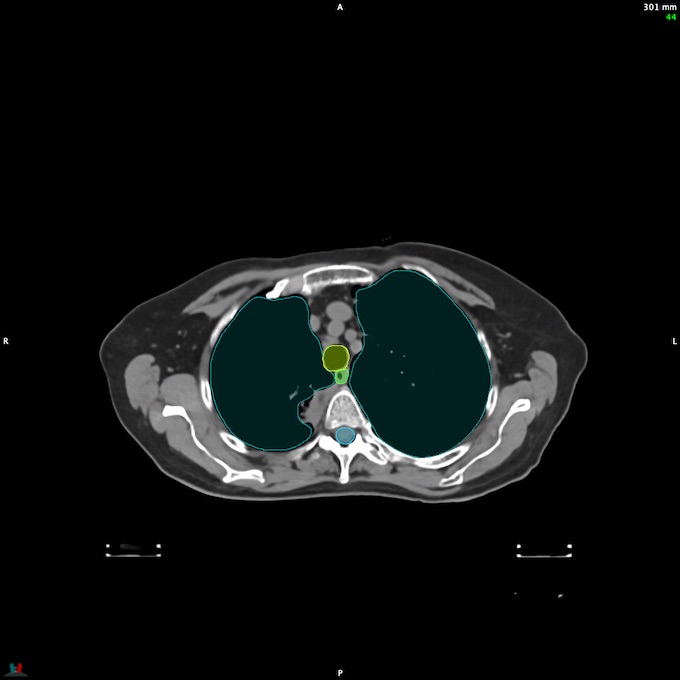 CT__SPINALCORD_43