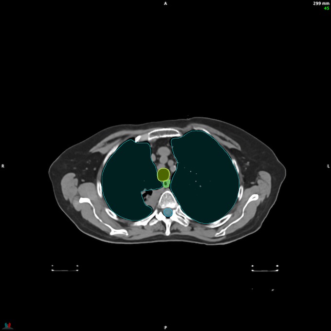 CT__SPINALCORD_44