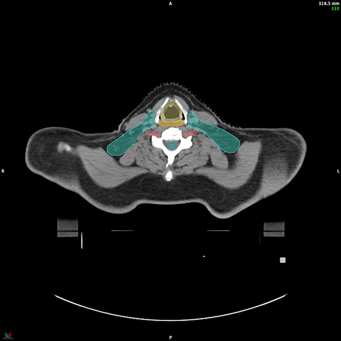 CT__SPINALCORD_44