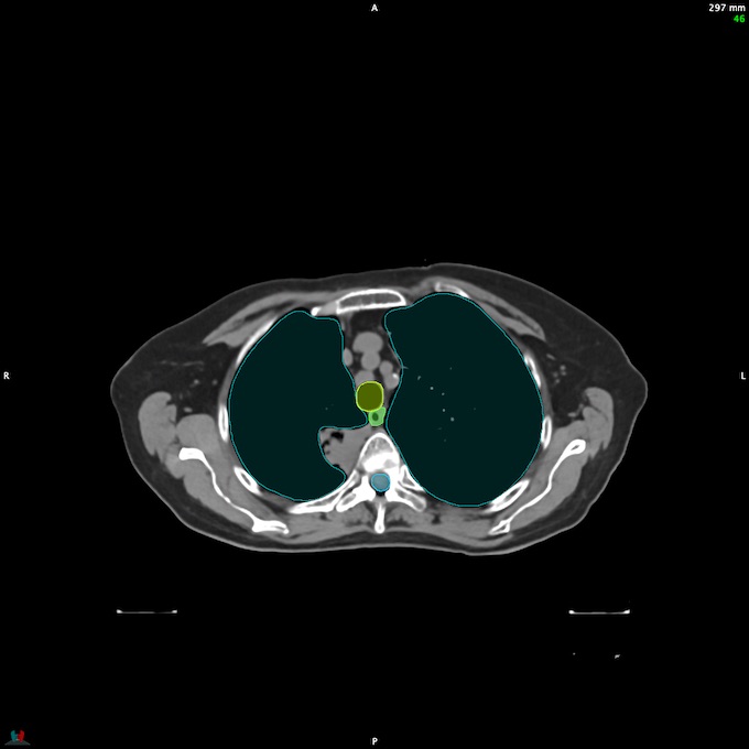 CT__SPINALCORD_45