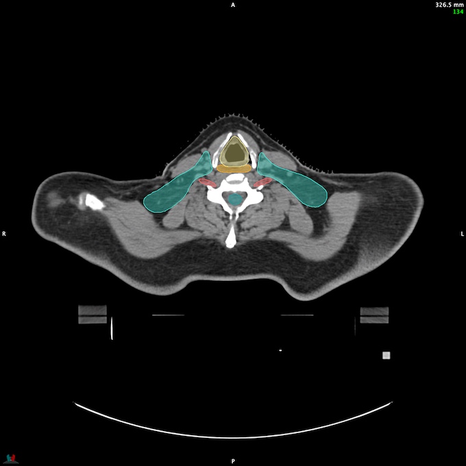 CT__SPINALCORD_45