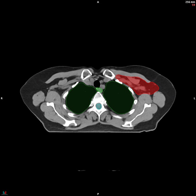 CT__SPINALCORD_46