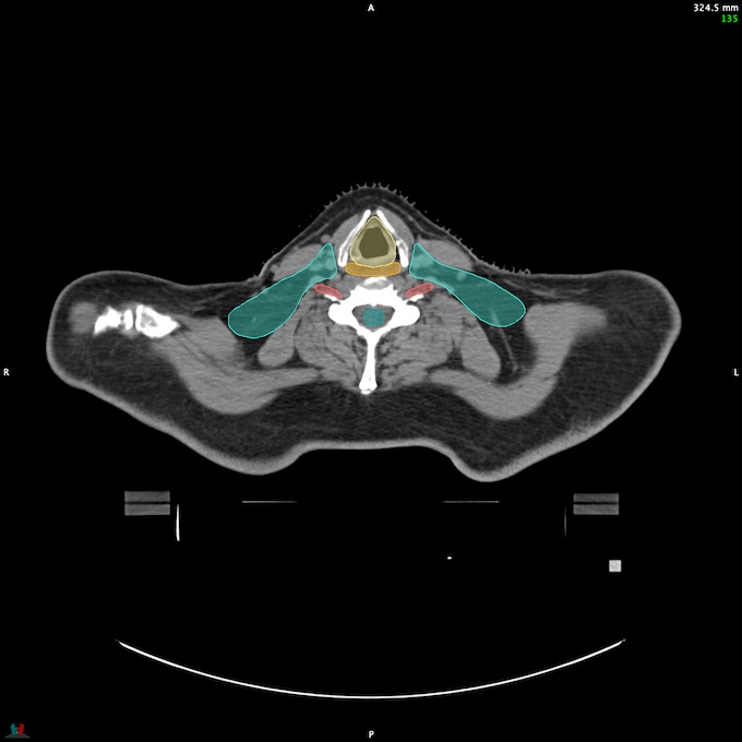 CT__SPINALCORD_46