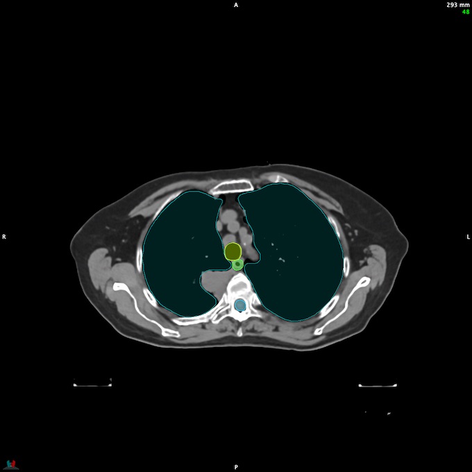 CT__SPINALCORD_47