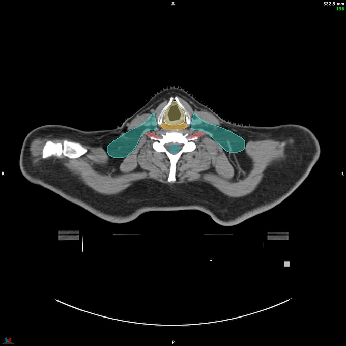 CT__SPINALCORD_47