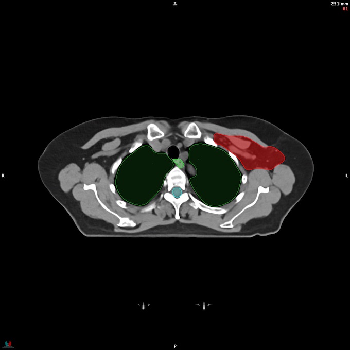 CT__SPINALCORD_48