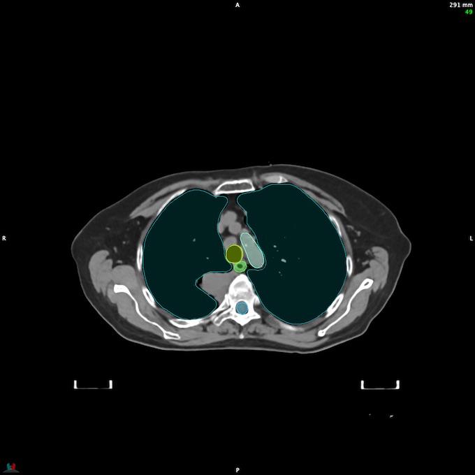 CT__SPINALCORD_48