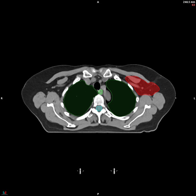 CT__SPINALCORD_49