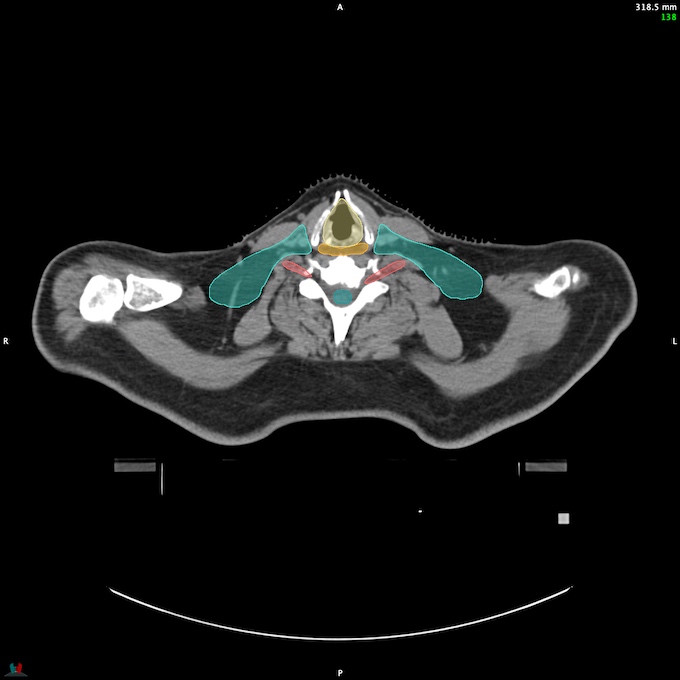 CT__SPINALCORD_49