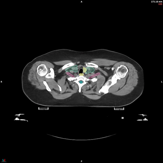 CT__SPINALCORD_49