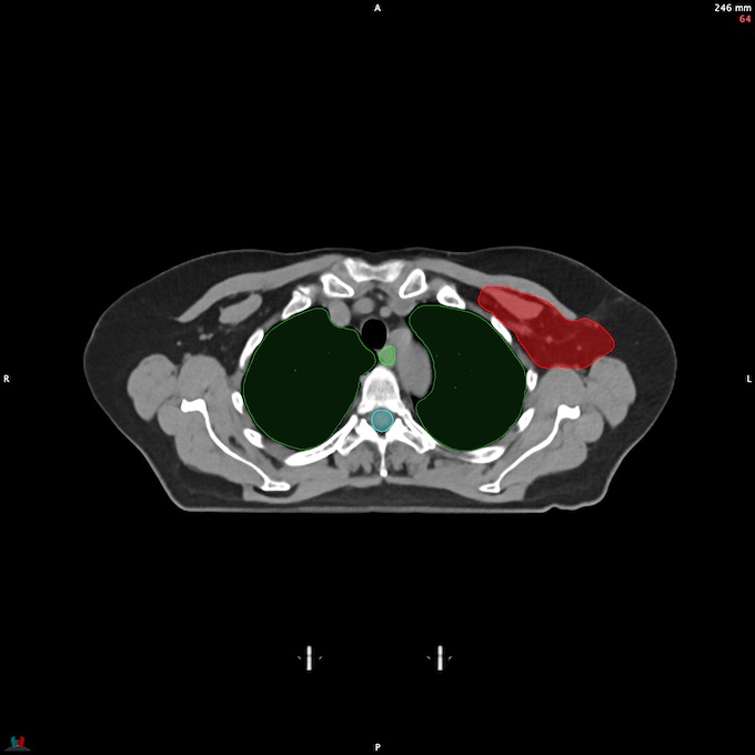 CT__SPINALCORD_50