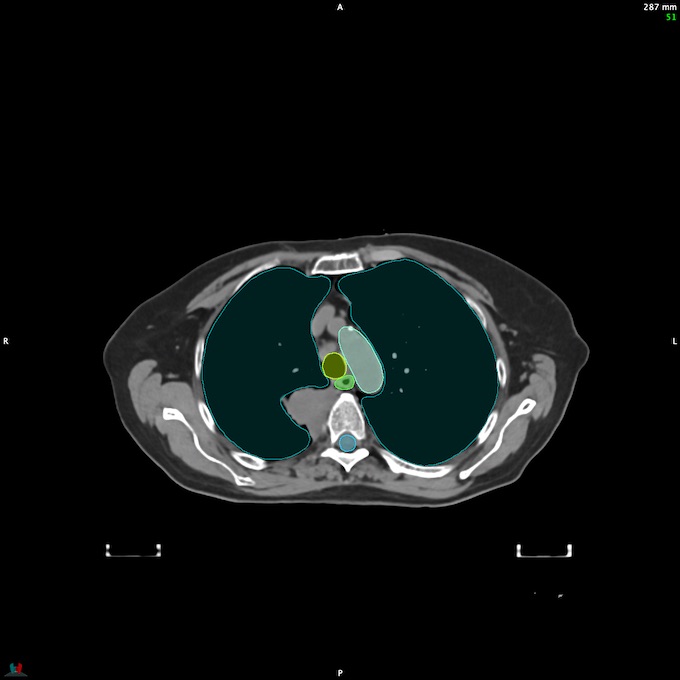 CT__SPINALCORD_50