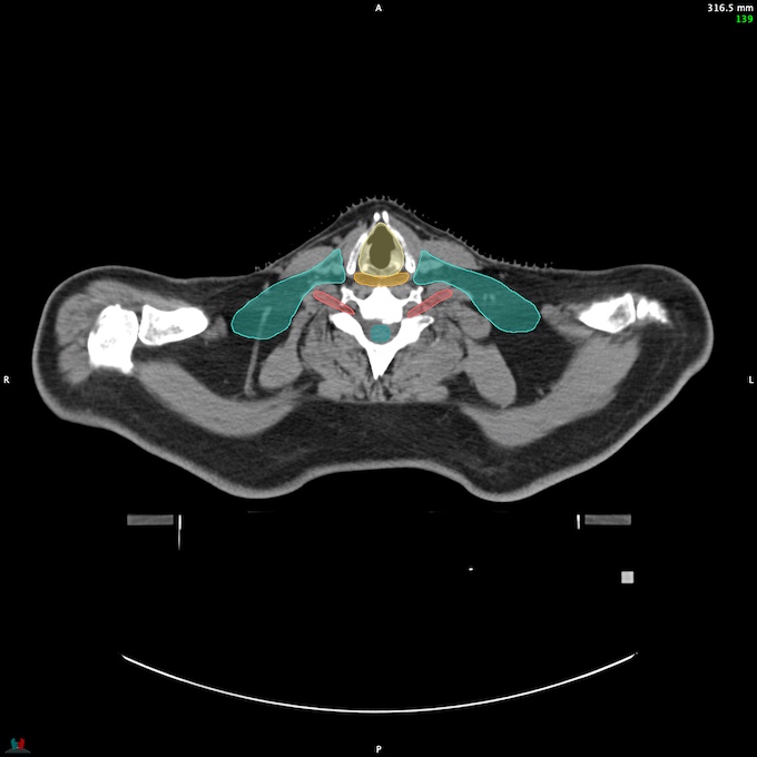 CT__SPINALCORD_50