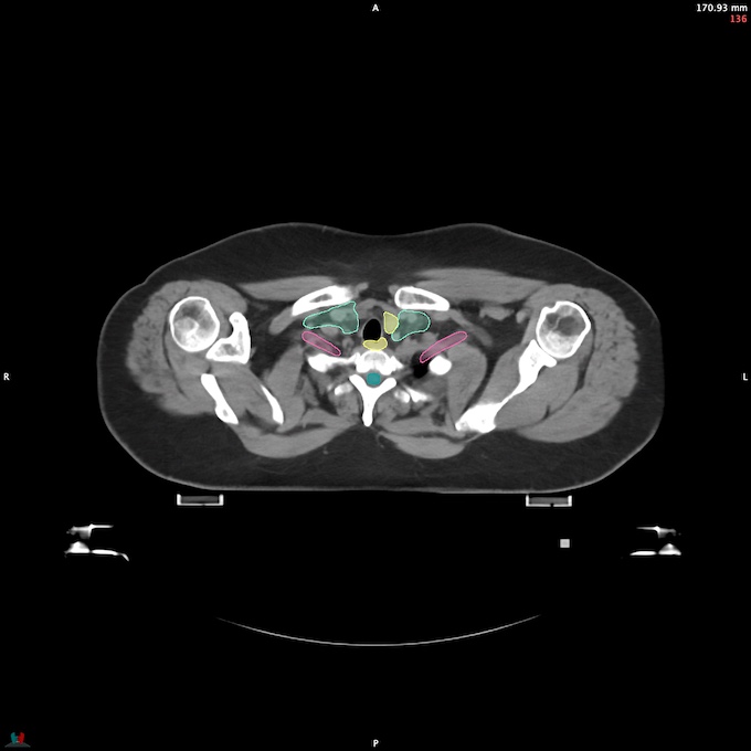 CT__SPINALCORD_50