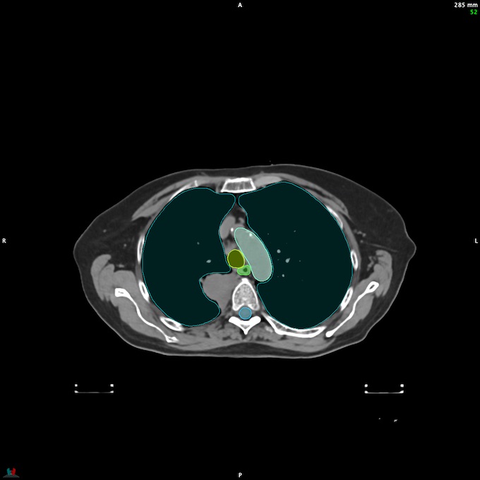 CT__SPINALCORD_51