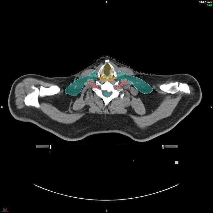 CT__SPINALCORD_51