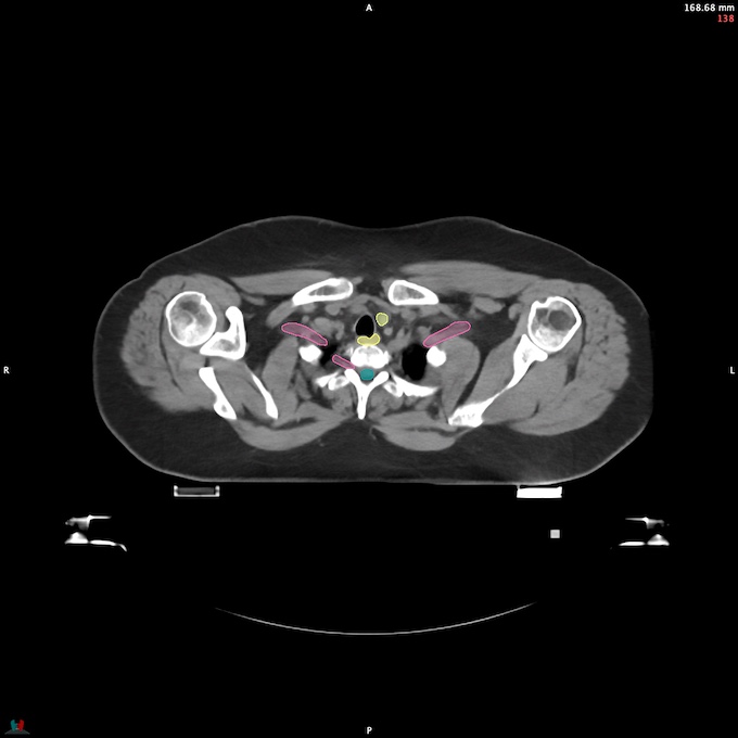 CT__SPINALCORD_51