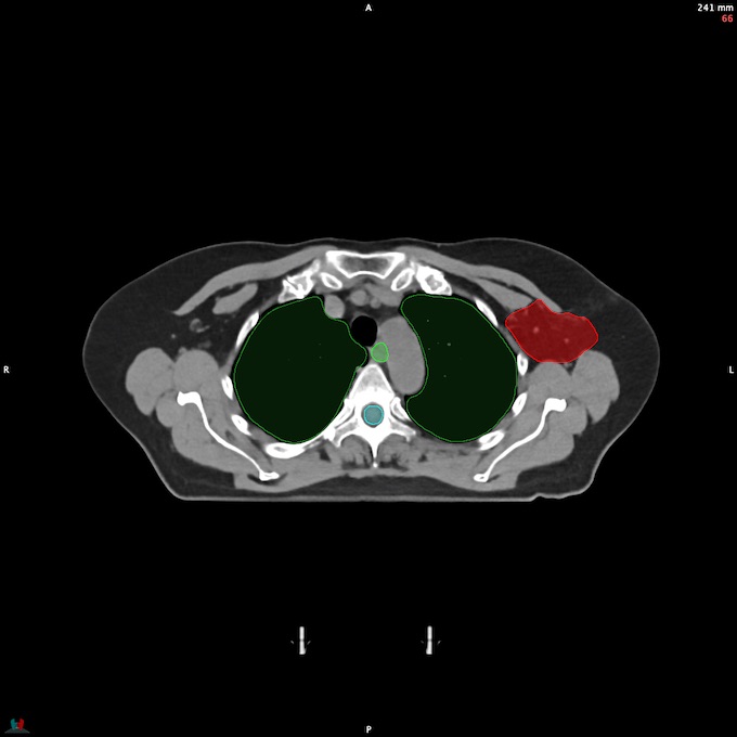 CT__SPINALCORD_52