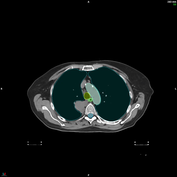 CT__SPINALCORD_52