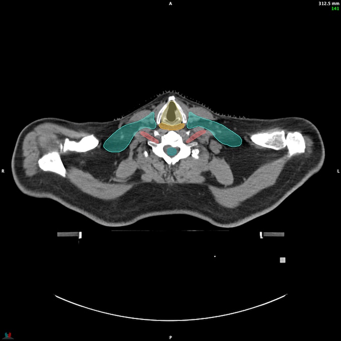 CT__SPINALCORD_52