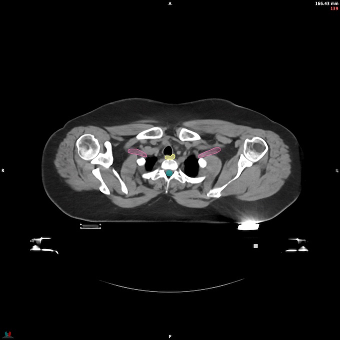 CT__SPINALCORD_52