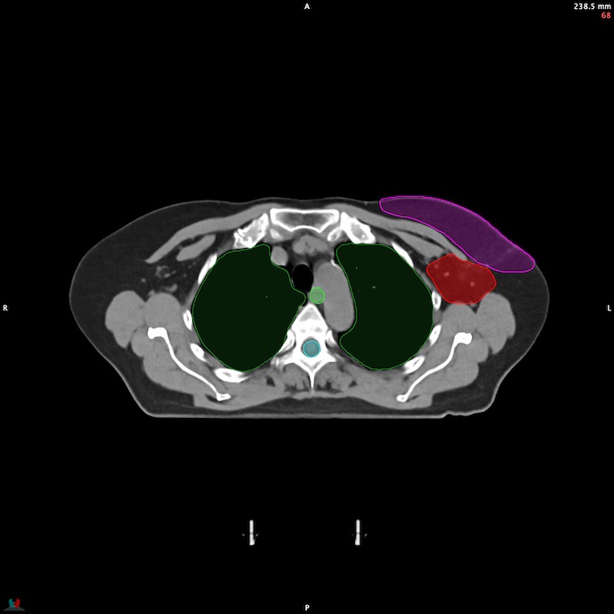 CT__SPINALCORD_53