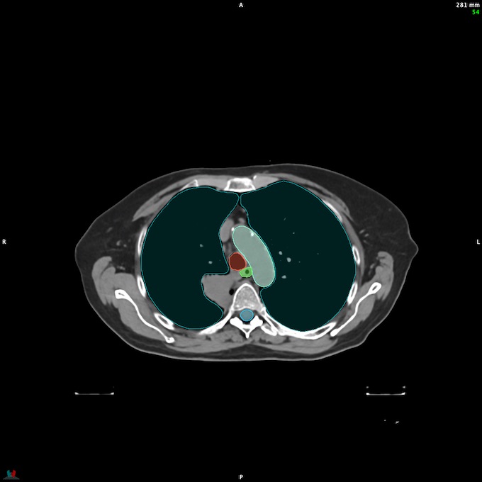 CT__SPINALCORD_53