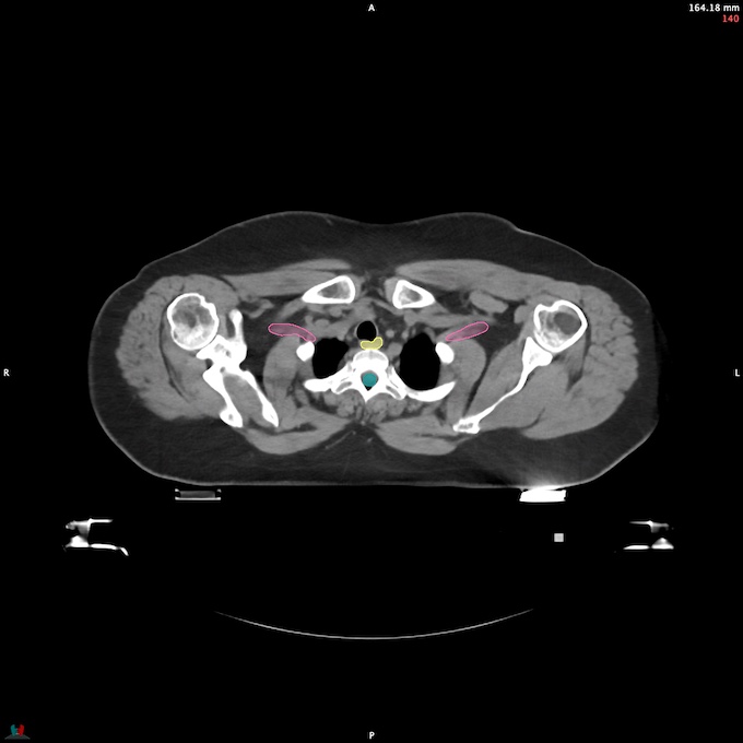 CT__SPINALCORD_53