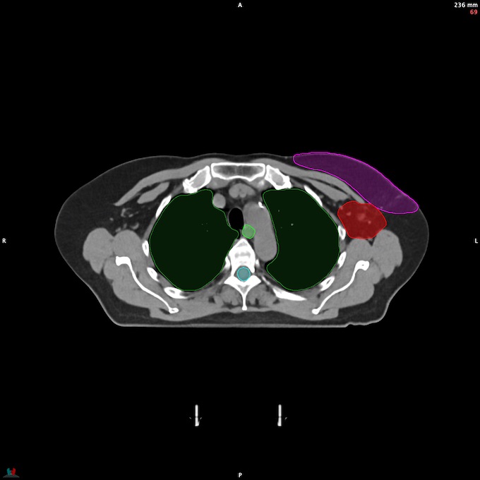 CT__SPINALCORD_54