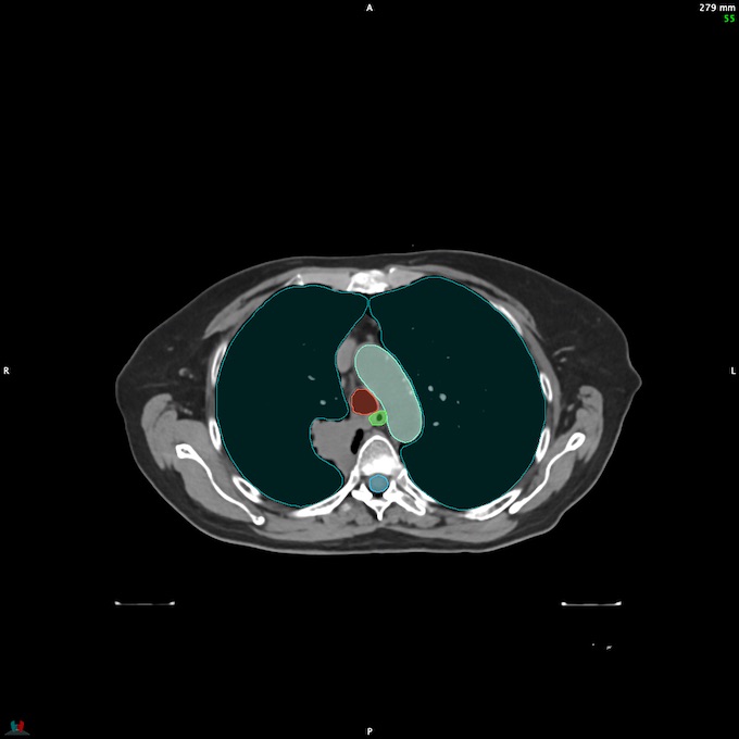 CT__SPINALCORD_54