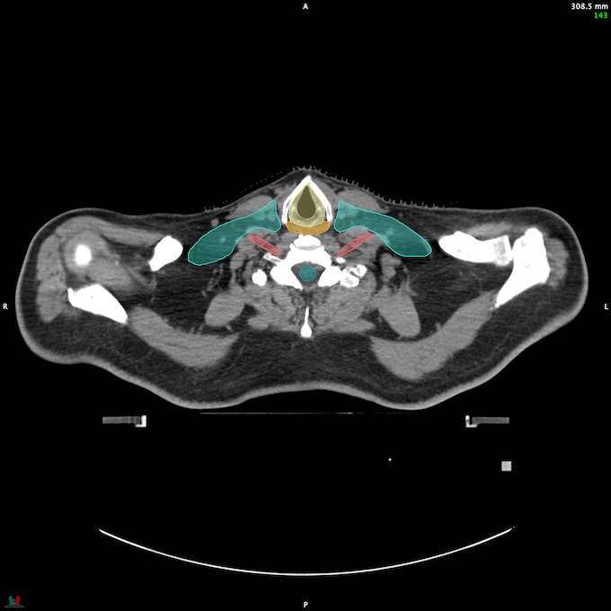 CT__SPINALCORD_54