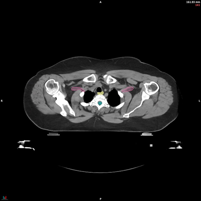 CT__SPINALCORD_54