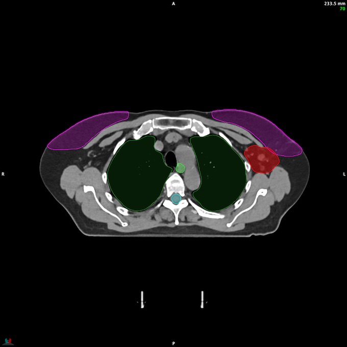 CT__SPINALCORD_55