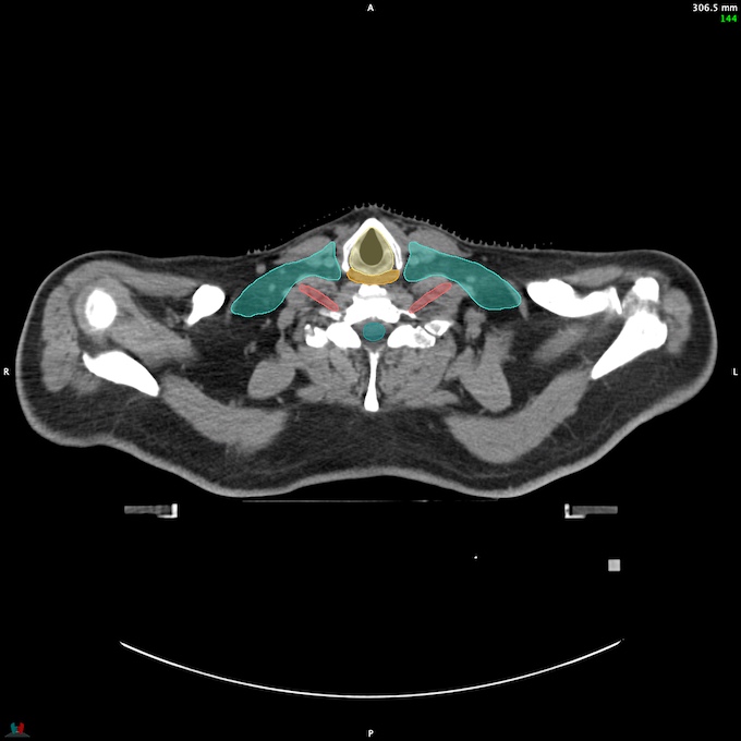 CT__SPINALCORD_55