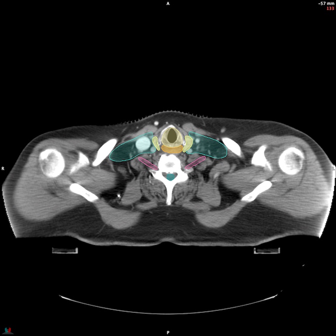 CT__SPINALCORD_56