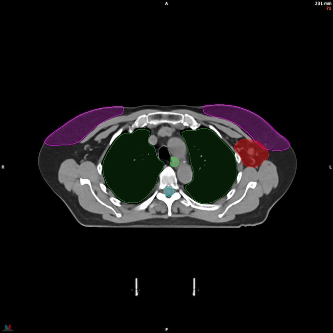 CT__SPINALCORD_56