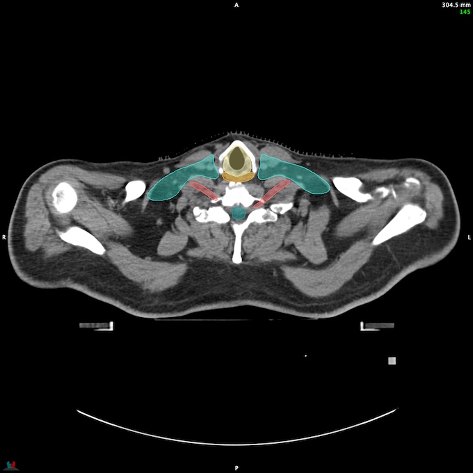 CT__SPINALCORD_56